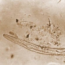 Intestinal Parasites: Signs, Symptoms & Natural Treatments RyDocs